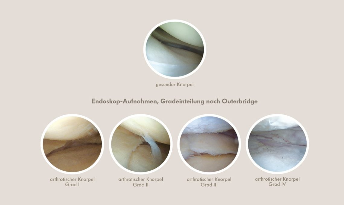 Arthrose Endoskopaufnahme
