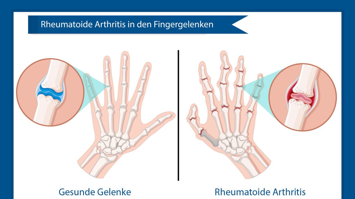 Rheumatoide Arthritis