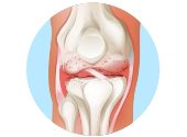Arthritis: Anzeichen &amp; Symptome