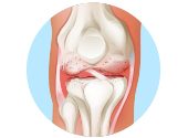 Arthritis: Anzeichen &amp; Symptome