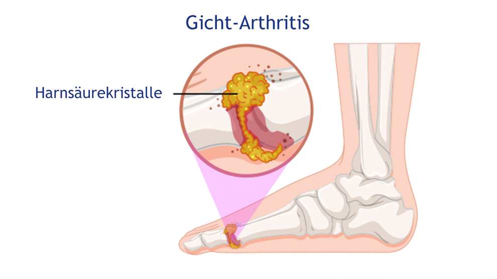 Anzeichen & Symptome Arthritis