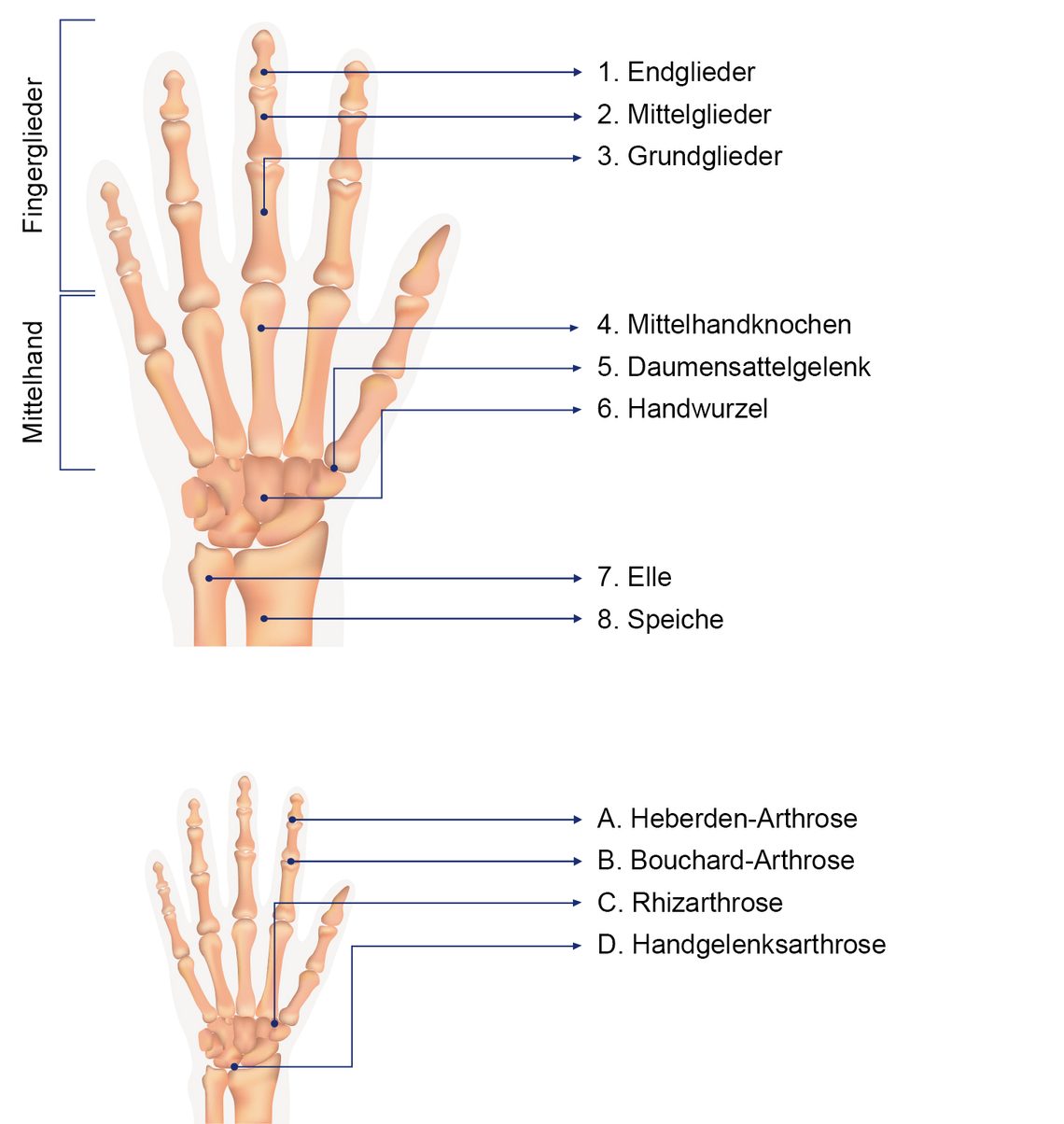 Handarthrose Gelenk