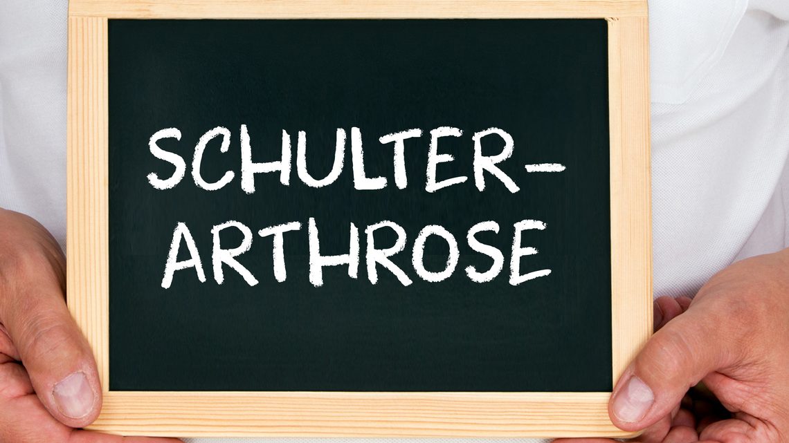 Schulterarthrose: Überblick