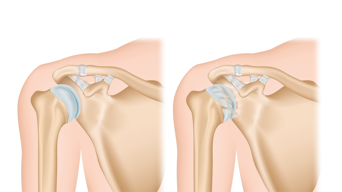 Schulterarthrose: Ursachen