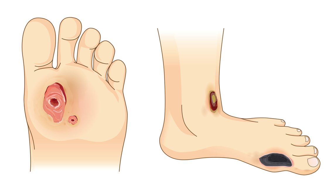 Das diabetische Fussulkus