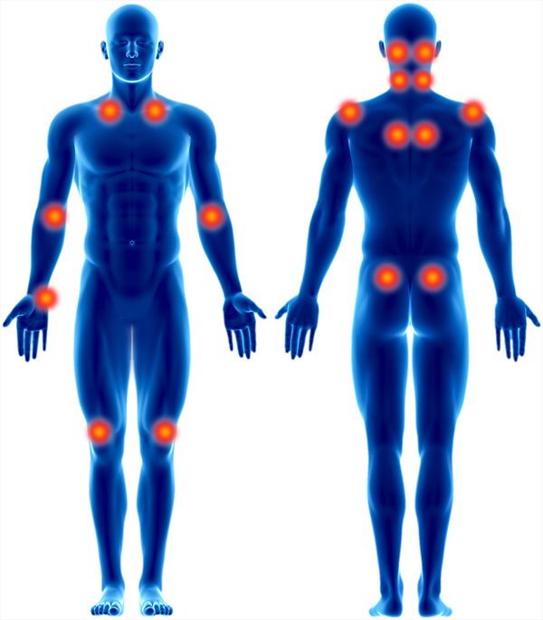 Alle Tenderpoints bei Fibromyalgie in einer anschaulichen Grafik