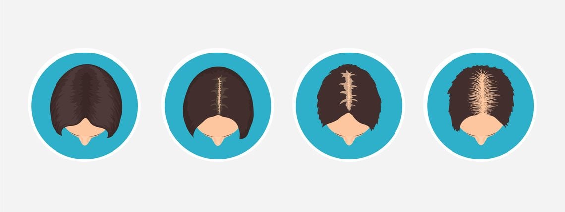 Erblich bedingter Haarausfall bei Frauen