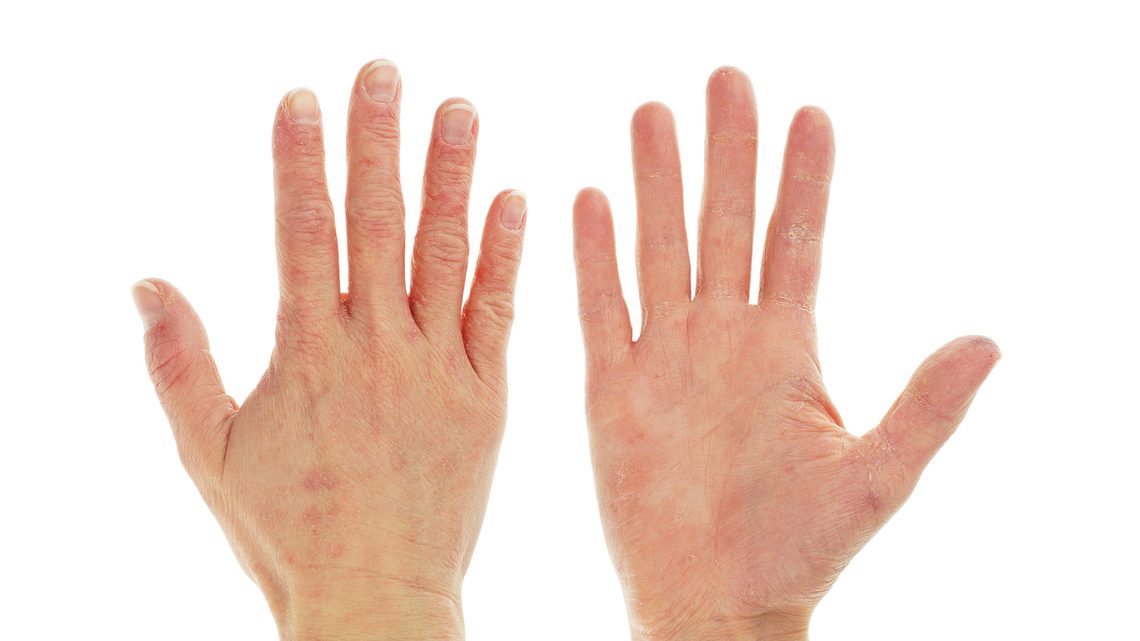 Dermatitis & Ekzeme: Symptome