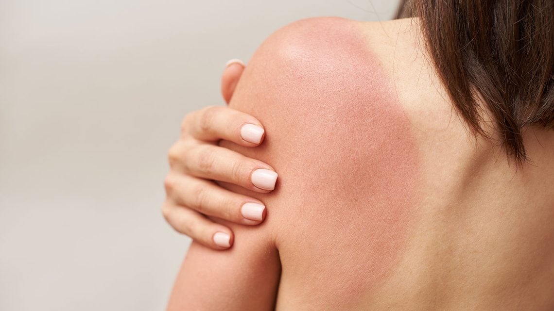 Sonnenbrand