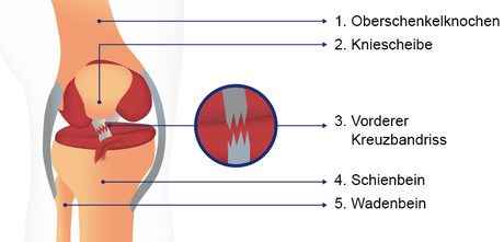 Vorderer Kreuzbandriss