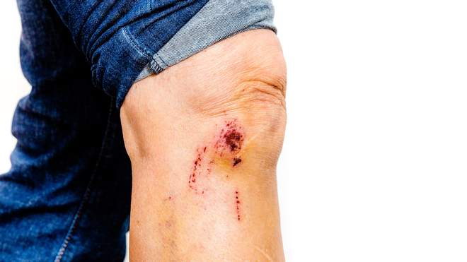 Sturz Auf Knie Mögliche Verletzungen www.was-tun-bei.ch