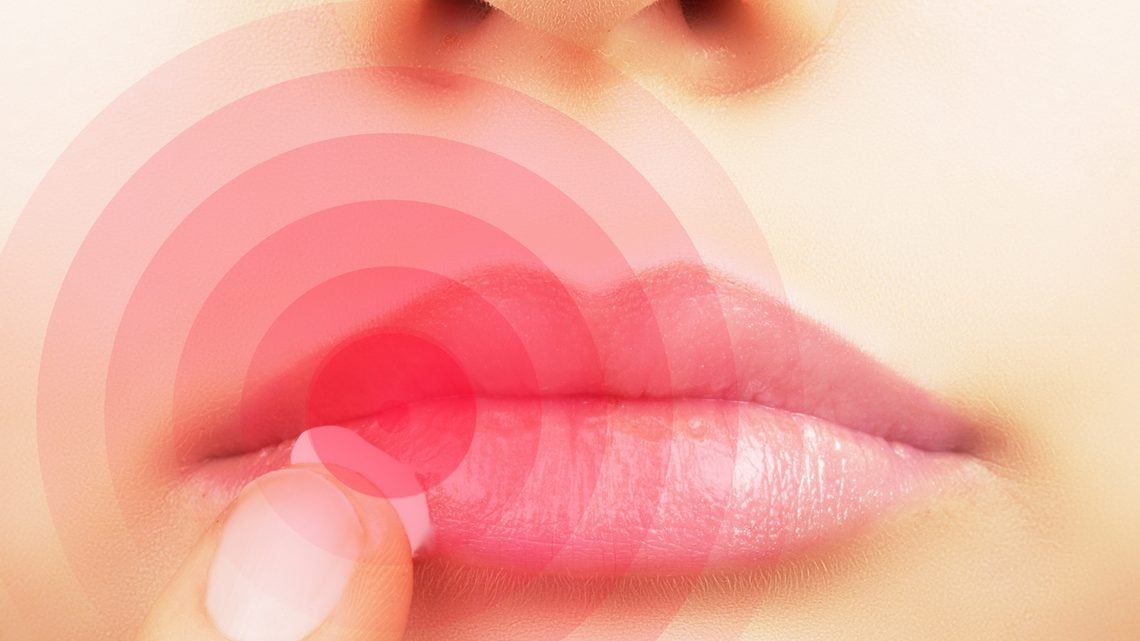 Lippenherpes behandeln