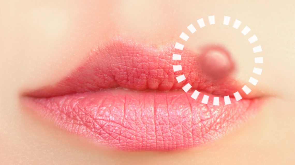 Lippenherpes: Ursachen