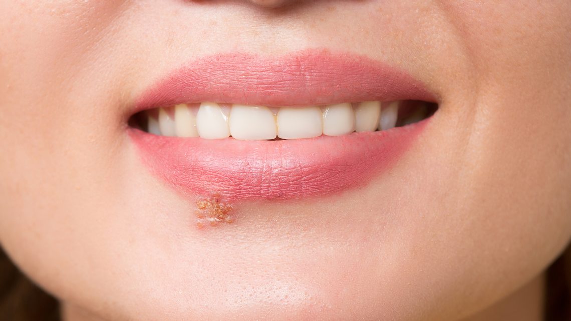 Lippenherpes vorbeugen: Tipps