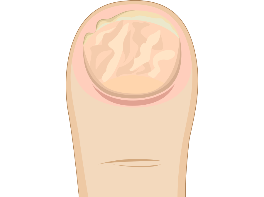 Nagelpilz Stufen