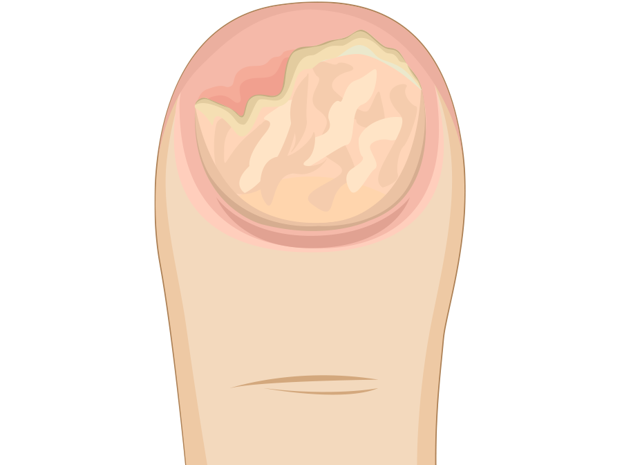 Nagelpilz Stufen