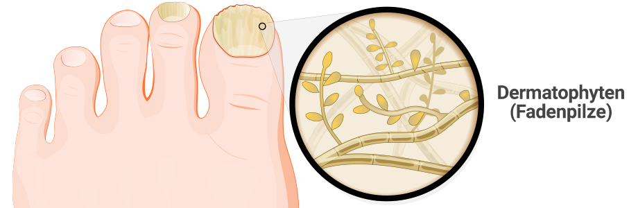 Pilzinfektion der Nägel