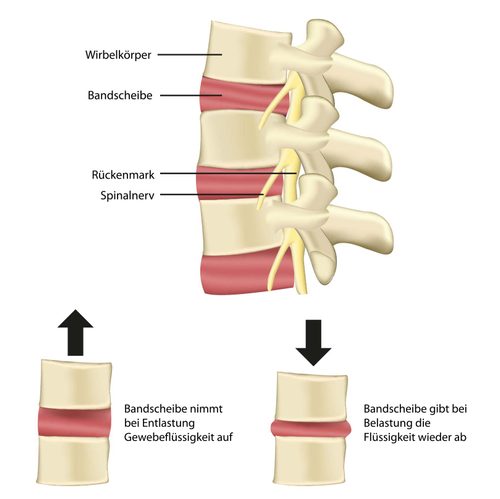 Bandscheibenvorfall – was ist das?