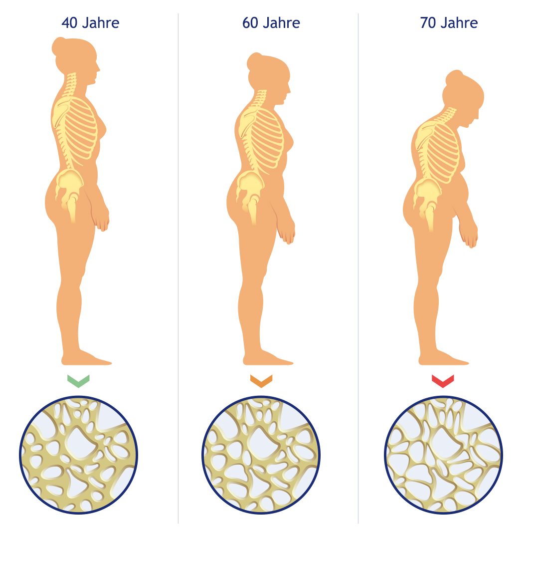 Osteoporose – „Witwenbuckel“