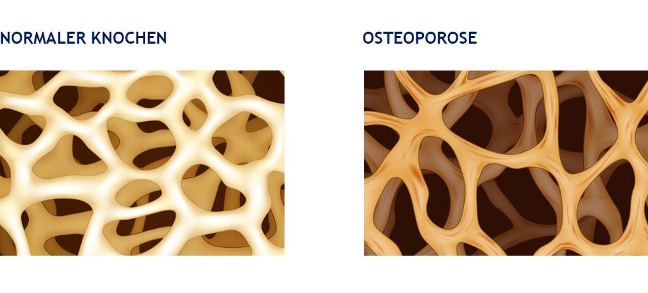 Osteoporose – Knochenaufbau