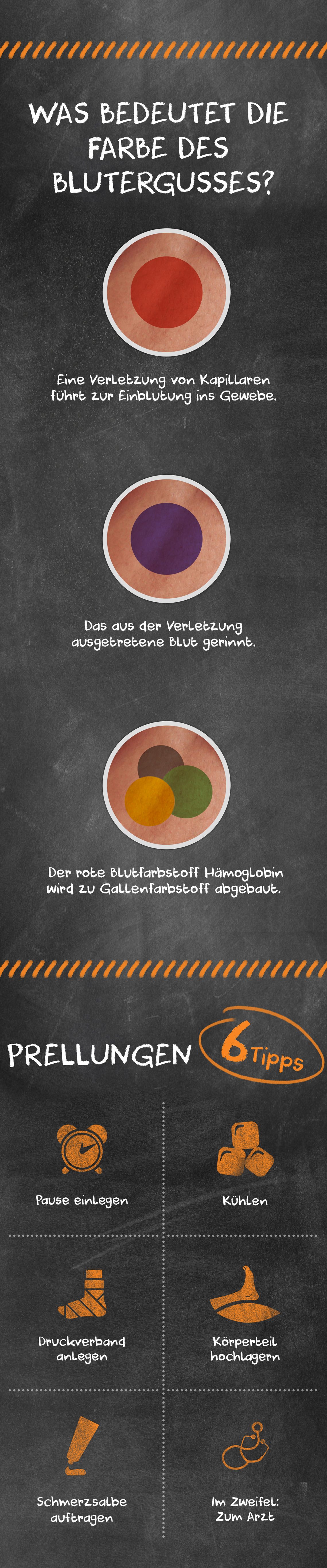 Prellungen: Infografik