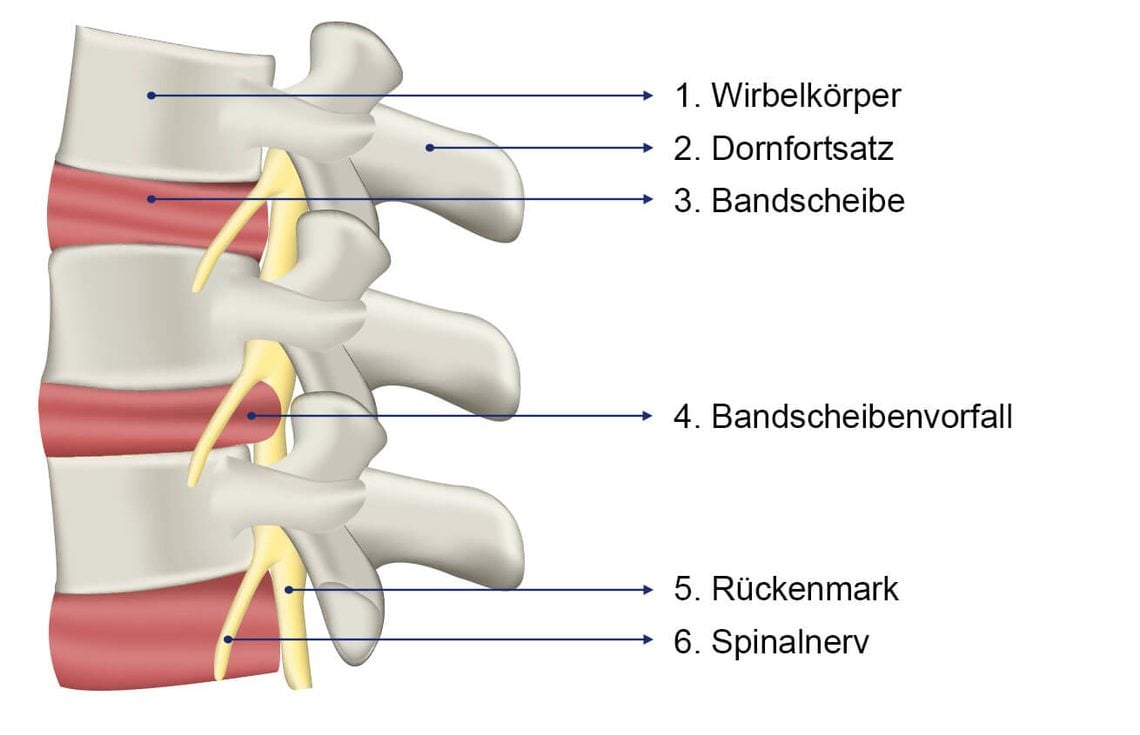 Bandscheibenvorfall