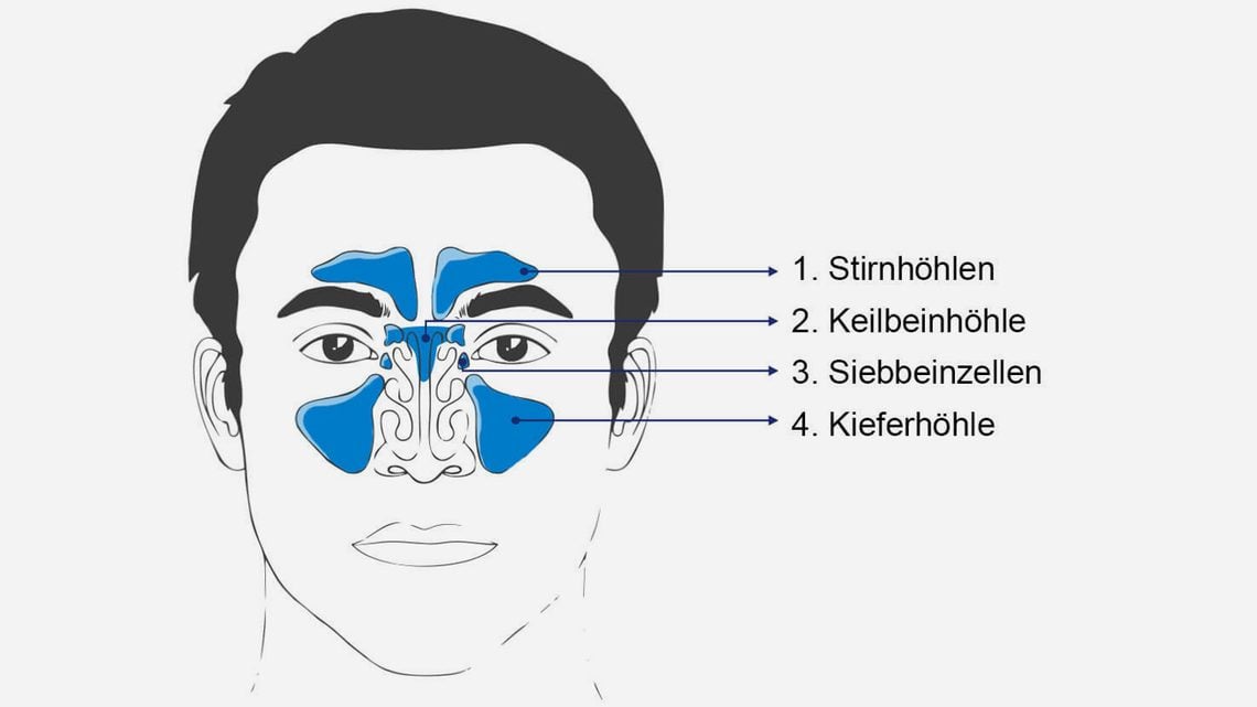 Sinusitis – was ist das?