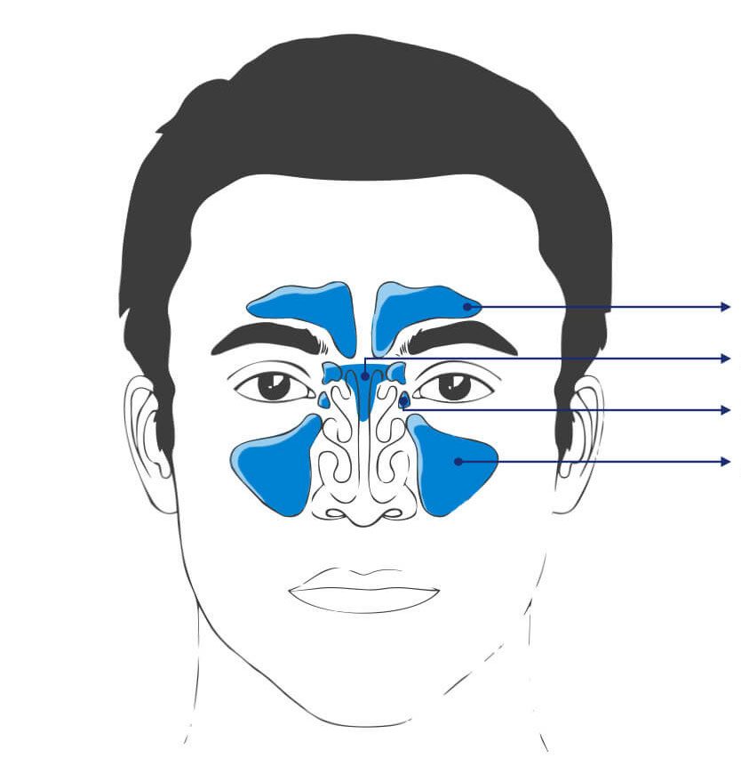 Was ist Sinusitis?