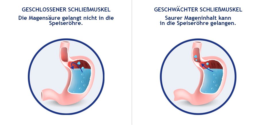 Sodbrennen: Entstehung