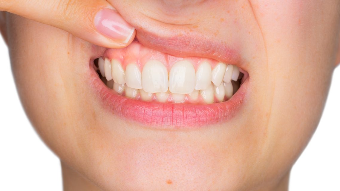 Selbsttest: Wie gesund ist Ihr Zahnfleisch?