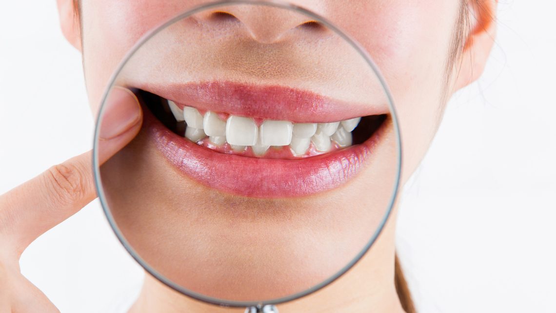 Gingivitis – was ist das?