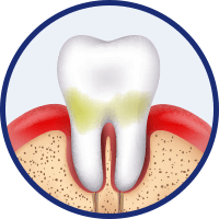 Gingivitis (Zahnfleischentzündung)