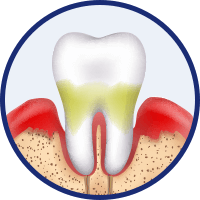 Parodontitis (Zahnbettentzündung)