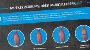 Steckbrief: Zerrung